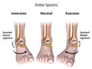 ankle sprain-thumb