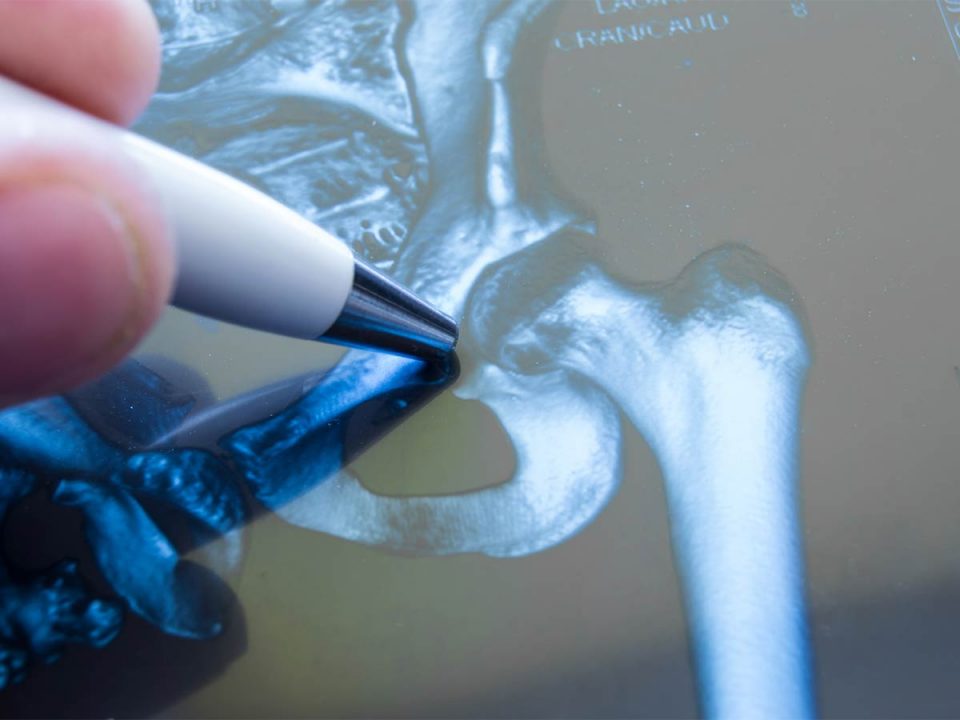 Hip Osteoarthritis BodyViva treatment