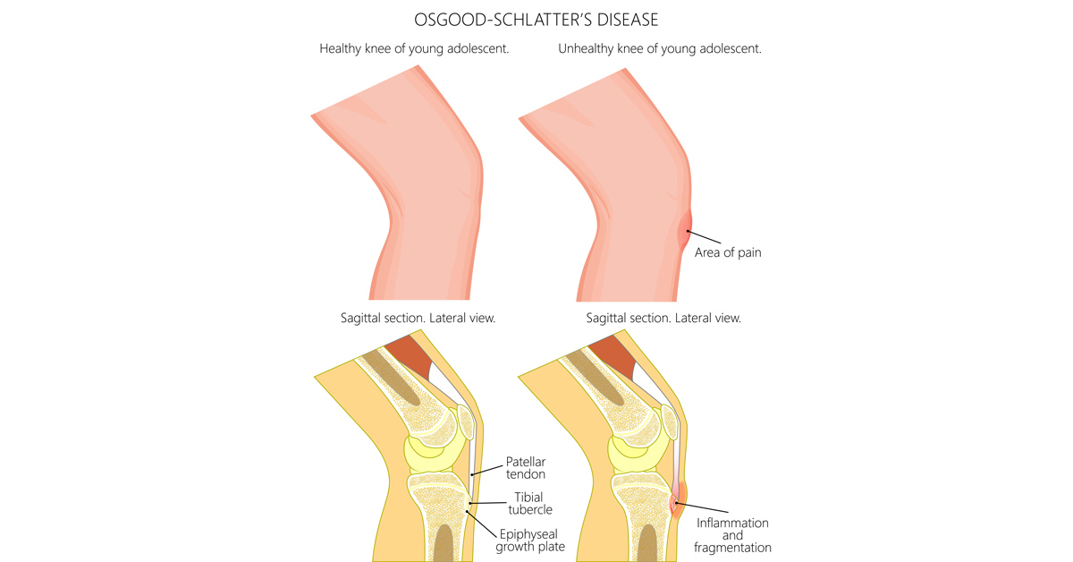 Pain below the knee Osgood Schlatter Disease