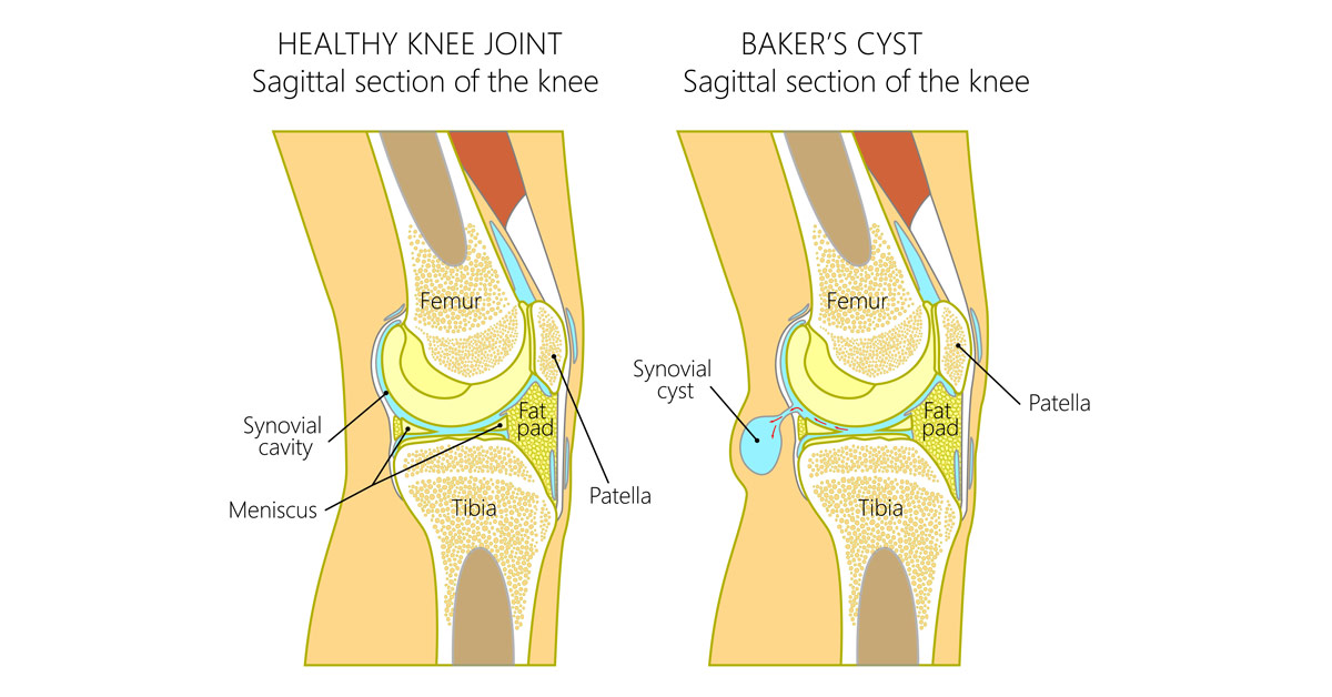 Baker’s cyst (Popliteal cyst) Physiotherapy BodyViva