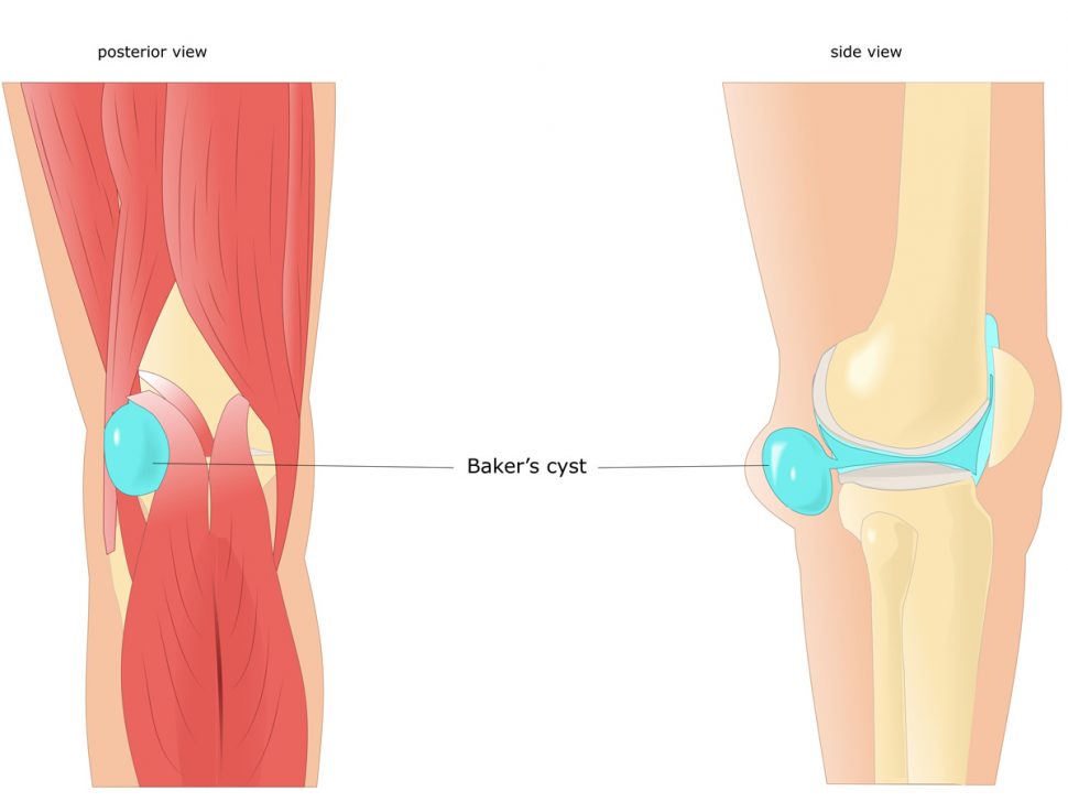 Baker’s cyst (Popliteal cyst) Physiotherapy BodyViva