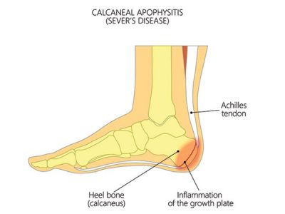Sever’s disease (Calcaneal Apophysitis)