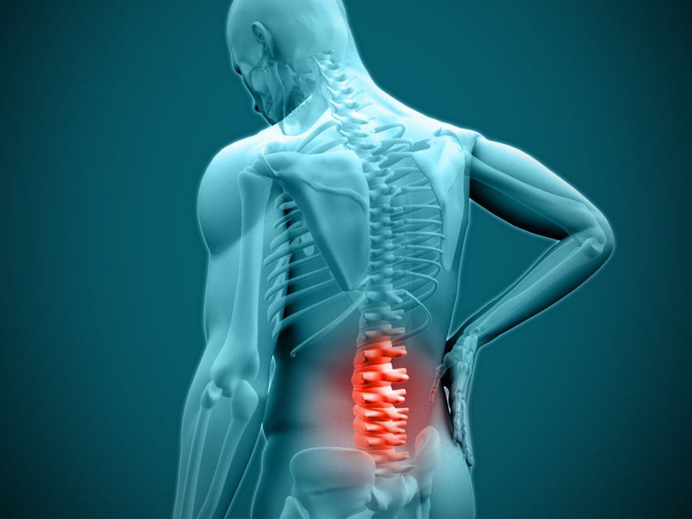 Spondylolysis (spinal stress fracture) BodyViva
