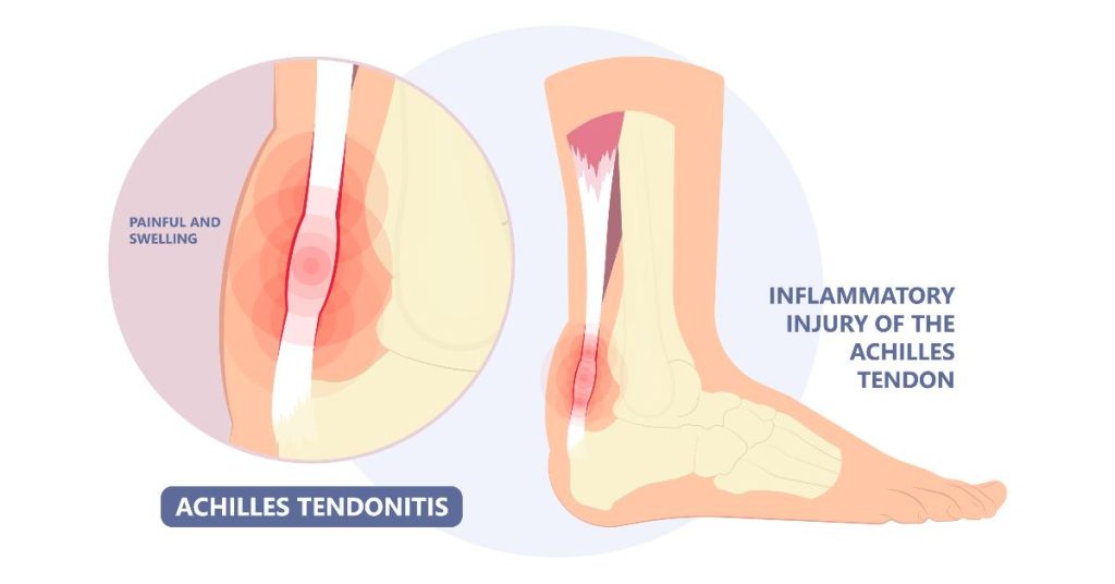 Graphic heat map of injured achilles, achilles tendonitis 